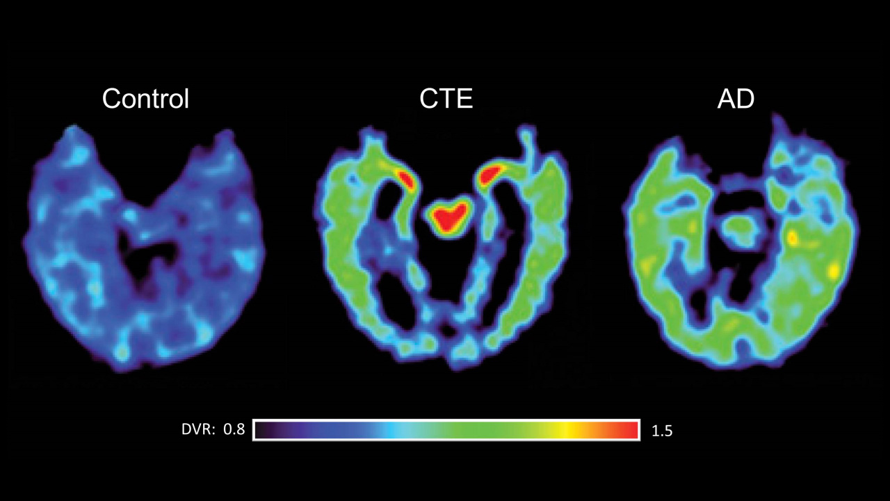 Traumatic Brain Injuries in Service Members Prompt Legislative Action