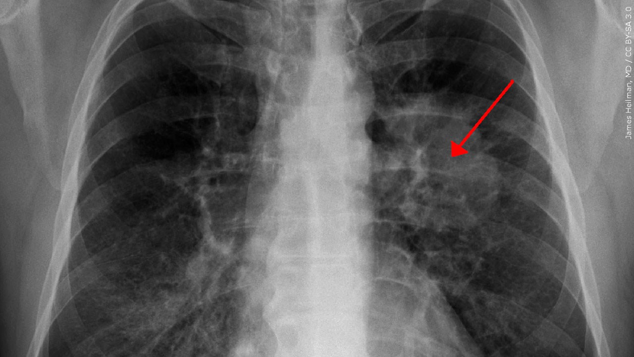 Report: U.S. Lung Cancer Survival Rate Rises 21%