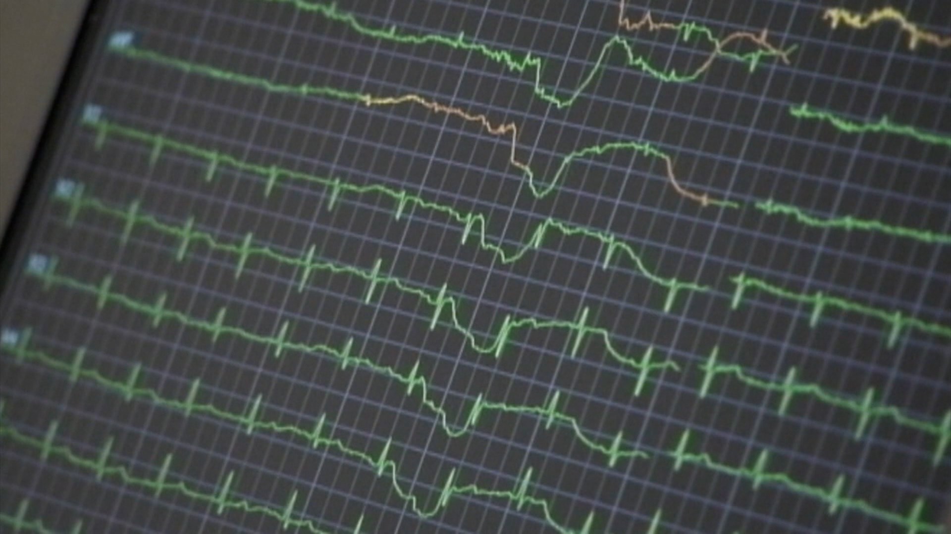 Heart Attack Deaths Up During the Holiday Season